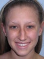 26 year old Caucasian American female for Rhinoplasty (nose job)