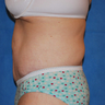 Body Lift