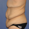 Body Lift
