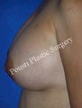 Nipple-Areola Repair
