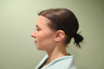 Rhinoplasty