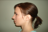 Rhinoplasty