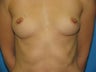 34 yr old with Silicone gel breast implants