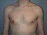 Male patient who underwent breast reduction