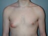 Male patient who underwent breast reduction