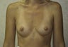 32 yr old female silicone gel implants 350cc sub-glandular