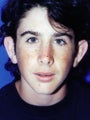 Otoplasty Male - Boy treated by Ear Surgery