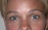 52 year old female patient underwent a brow lift 