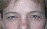 52 year old female patient underwent a brow lift 