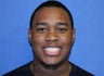 A young man with large underbite treated with Jaw Surgery (Orthognathic Surgery)