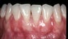 Gum Grafting  