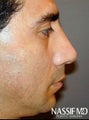 Hispanic Male Rhinoplasty 