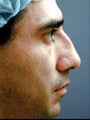 Hispanic Male Rhinoplasty 