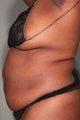 55 Year Old Female Treated for Unwanted Fat with SmartLipo  and Vaser Laser & Fat Transfer