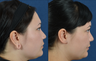 Stretched (gauge) Earlobe Repair - stretched to 1.25"