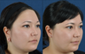 Stretched (gauge) Earlobe Repair - stretched to 1.25"