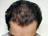 Mesotherapy