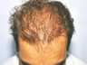 Mesotherapy