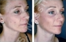 Complete Facial Rejuvenation