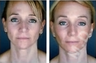 Complete Facial Rejuvenation