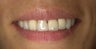 Smile Makeover