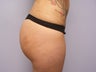 Brazilian Butt Lift 