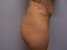Brazilian Butt Lift 