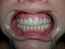 Porcelain Veneers