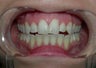 Porcelain Veneers