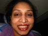 Teeth Whitening