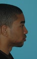Rhinoplasty