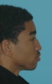 Rhinoplasty