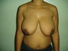 25 year woman treated with breast reduction
