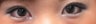 Bilateral Asian Eyelid Surgery