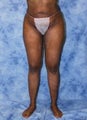 Brazilian Butt Lift and creating curves