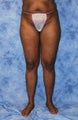 Brazilian Butt Lift and creating curves