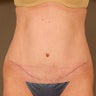 33 Year Old Female Underwent a Tummy Tuck After Pregnancy