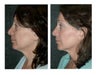 Lower Eyelid Lift (Extended) with Fat Transposition for Eye Bags