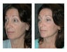 Lower Eyelid Lift (Extended) with Fat Transposition for Eye Bags