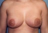 Tuberous Breast Augmentation (Dual Plane ) + Periareolar Mastopexy