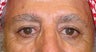 Brow Lift