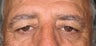 Brow Lift
