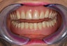 Implant-Supported Lower Denture