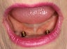 Implant-Supported Lower Denture