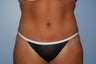 Tummy Tuck