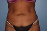 Tummy Tuck
