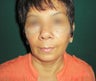 Facelift