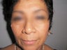 Facelift