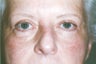 Blepharoplasty