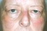 Blepharoplasty